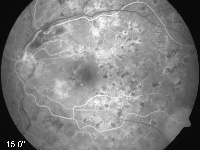 Argonlaser